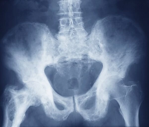 Pelvis in Pagets disease, X-ray