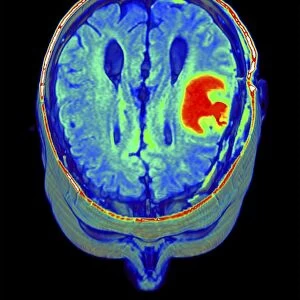 Brain tumour, 3D-MRI scan
